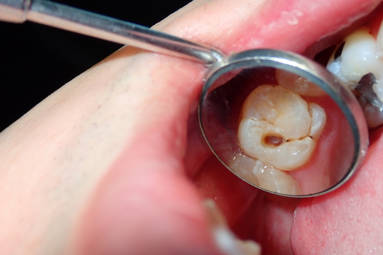 Featured image for “Autoimmune Diseases That Cause Tooth Decay”
