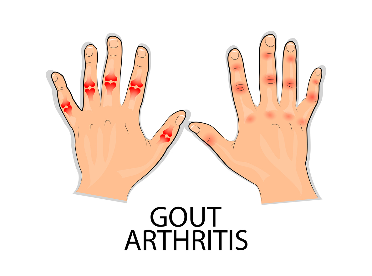 Featured image for “Systemic Arthritis: Understanding SJIA”